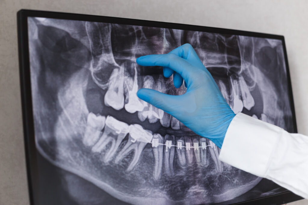 Root Canal Therapy, dental x-ray