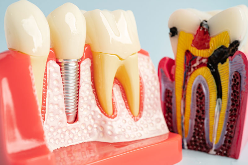 Dental Implants